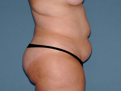 Tummy Tuck - Abdominoplasty Before & After Patient #3315