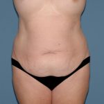Tummy Tuck - Abdominoplasty Before & After Patient #3388
