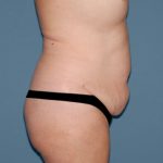 Tummy Tuck - Abdominoplasty Before & After Patient #3388