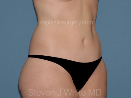 Tummy Tuck - Abdominoplasty Before & After Patient #3389