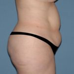 Tummy Tuck - Abdominoplasty Before & After Patient #3389