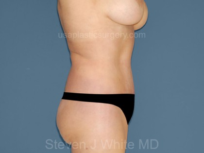 Tummy Tuck - Abdominoplasty Before & After Patient #3390