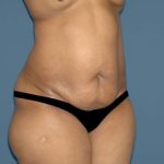 Tummy Tuck - Abdominoplasty Before & After Patient #3391