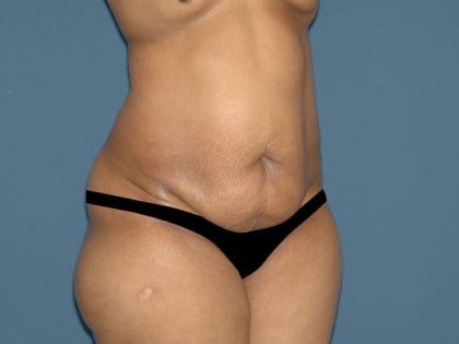 Tummy Tuck - Abdominoplasty Before & After Patient #3391