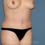 Tummy Tuck - Abdominoplasty Before & After Patient #3392