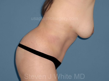 Tummy Tuck - Abdominoplasty Before & After Patient #3392