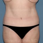 Tummy Tuck - Abdominoplasty Before & After Patient #3393