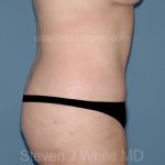 Tummy Tuck - Abdominoplasty Before & After Patient #3393