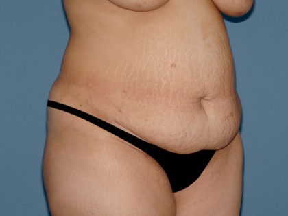 Tummy Tuck - Abdominoplasty Before & After Patient #3394