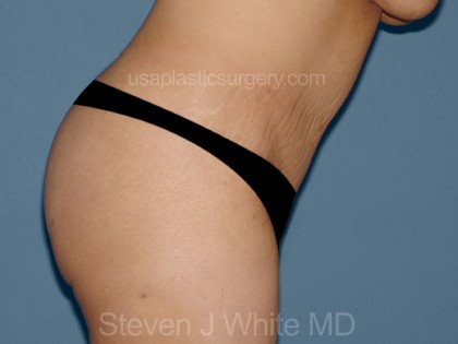 Tummy Tuck - Abdominoplasty Before & After Patient #3394