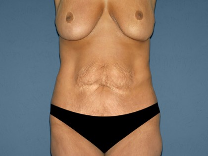 Tummy Tuck - Abdominoplasty Before & After Patient #3181