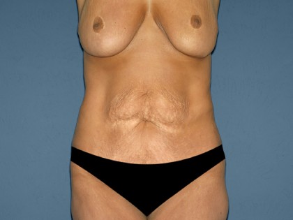 Patient #3181 Tummy Tuck - Abdominoplasty Before and After Photos Dallas,  TX - Plastic Surgery Gallery Dr. Steven J. White