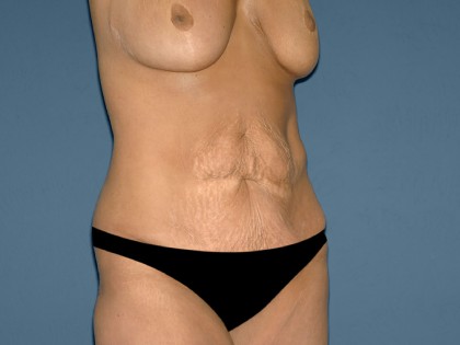 Tummy Tuck - Abdominoplasty Before & After Patient #3181