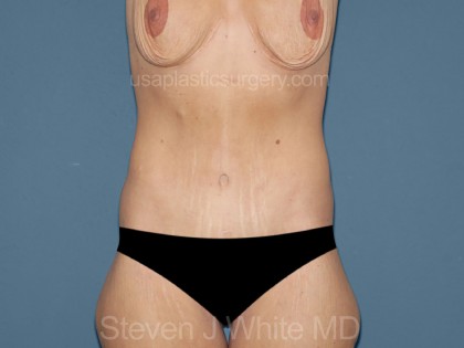 Tummy Tuck - Abdominoplasty Before & After Patient #3182