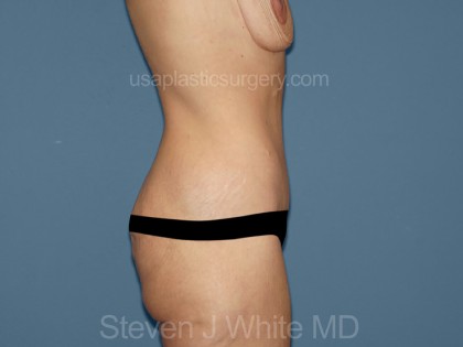 Tummy Tuck - Abdominoplasty Before & After Patient #3182