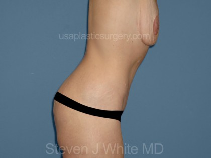 Tummy Tuck - Abdominoplasty Before & After Patient #3182