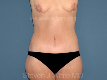 Tummy Tuck Patient #10  Plastic Surgeon Dallas