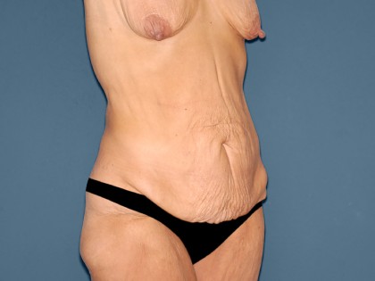 Tummy Tuck - Abdominoplasty Before & After Patient #3183