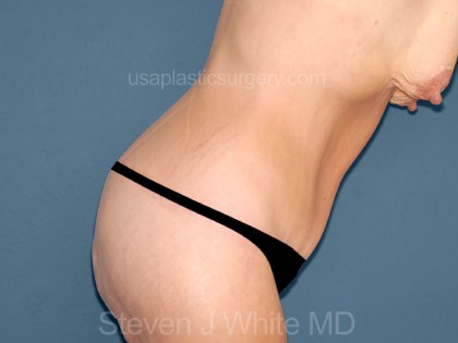 Tummy Tuck - Abdominoplasty Before & After Patient #3183