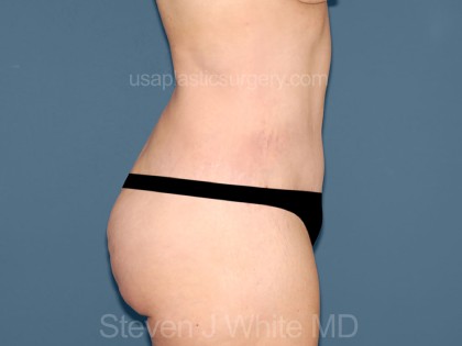 Tummy Tuck - Abdominoplasty Before & After Patient #3185