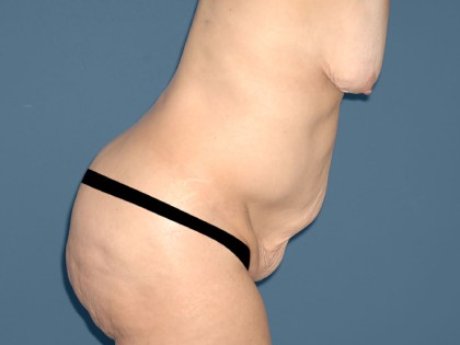 Tummy Tuck - Abdominoplasty Before & After Patient #3185