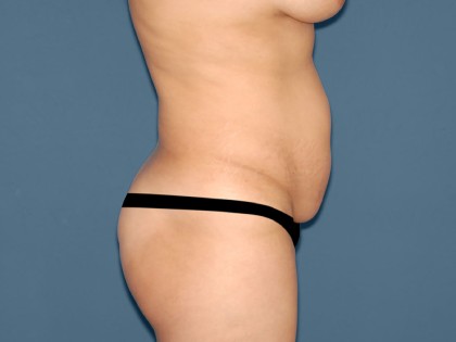 Tummy Tuck - Abdominoplasty Before & After Patient #3312