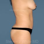 Tummy Tuck - Abdominoplasty Before & After Patient #3312