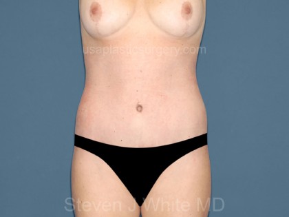 Tummy Tuck - Abdominoplasty Before & After Patient #3313