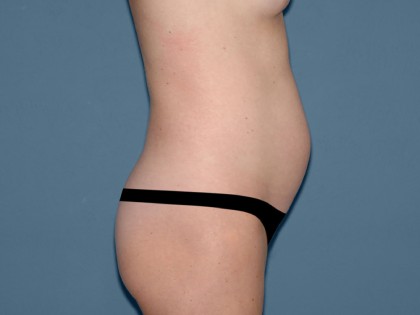 Tummy Tuck - Abdominoplasty Before & After Patient #3313