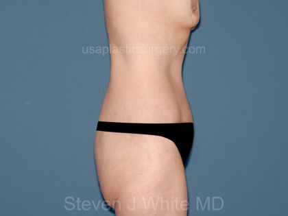 Tummy Tuck - Abdominoplasty Before & After Patient #3314