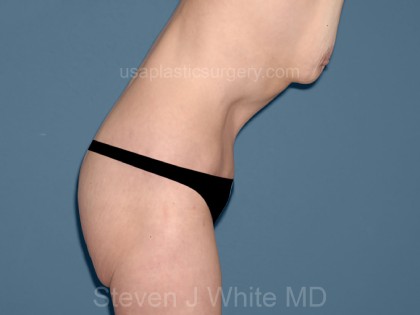 Tummy Tuck - Abdominoplasty Before & After Patient #3314