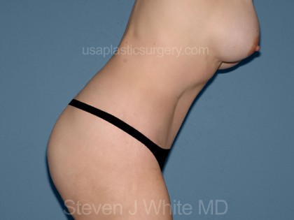 Tummy Tuck - Abdominoplasty Before & After Patient #3180