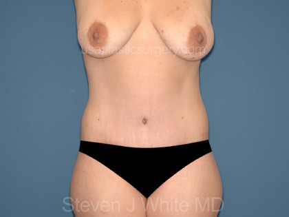 Tummy Tuck - Abdominoplasty Before & After Patient #3307