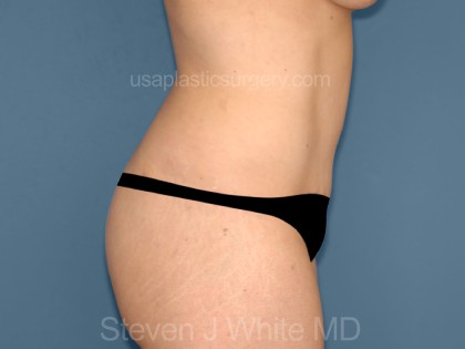 Tummy Tuck - Abdominoplasty Before & After Patient #3307