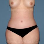Tummy Tuck - Abdominoplasty Before & After Patient #3308