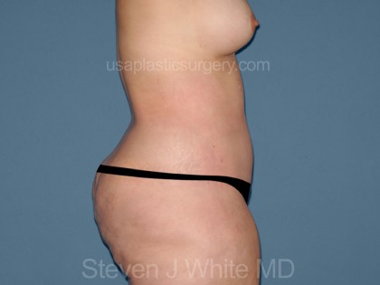 Tummy Tuck - Abdominoplasty Before & After Patient #3308