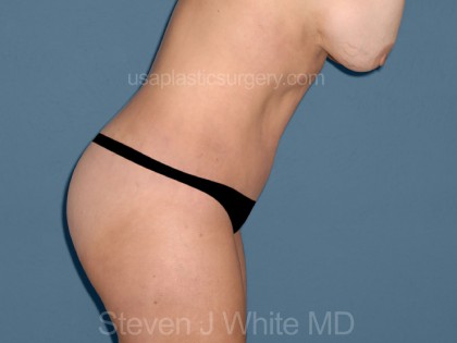 Tummy Tuck - Abdominoplasty Before & After Patient #3189