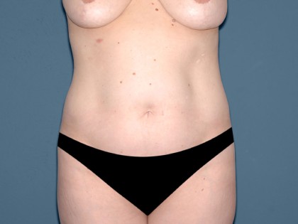 Tummy Tuck - Abdominoplasty Before & After Patient #3397