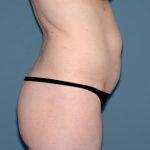 Tummy Tuck - Abdominoplasty Before & After Patient #3397