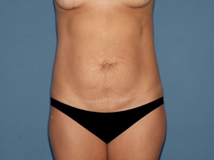 Tummy Tuck - Abdominoplasty Before & After Patient #3398