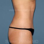 Tummy Tuck - Abdominoplasty Before & After Patient #3398