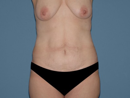 Tummy Tuck - Abdominoplasty Before & After Patient #3399