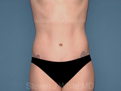 Tummy Tuck - Abdominoplasty Before & After Patient #3186