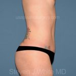Tummy Tuck - Abdominoplasty Before & After Patient #3186
