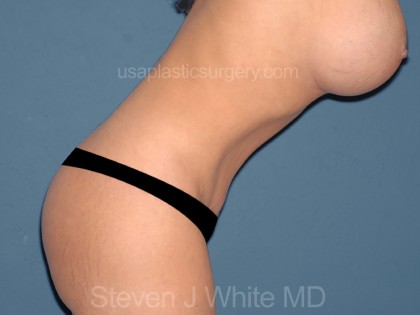 Tummy Tuck - Abdominoplasty Before & After Patient #3187