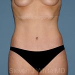 Tummy Tuck - Abdominoplasty Before & After Patient #3188