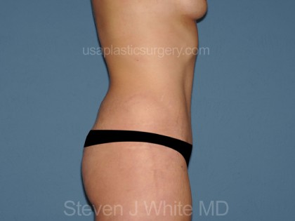 Tummy Tuck - Abdominoplasty Before & After Patient #3188