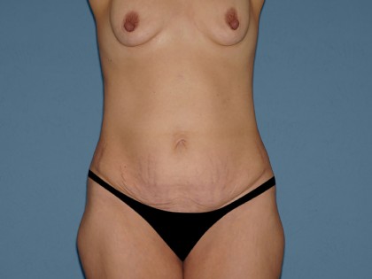 Tummy Tuck - Abdominoplasty Before & After Patient #3309