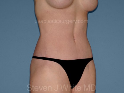 Tummy Tuck - Abdominoplasty Before & After Patient #3309