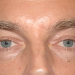 Eyelid Surgery - Blepharoplasty - Lower Eyelids Before & After Patient #5474